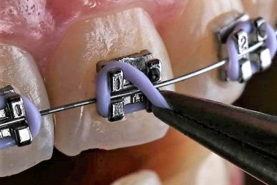 Niềng răng có làm răng bị yếu không?