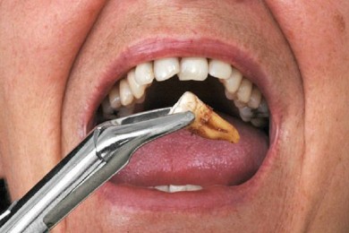 Điều trị nha khoa