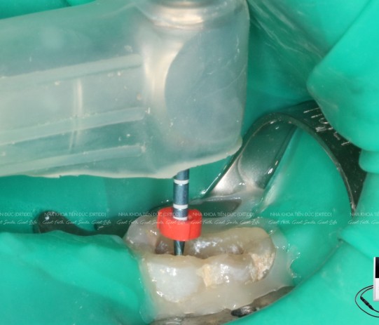 Điều trị tủy răng