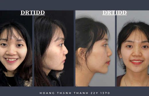 Ảnh khách hàng điều trị Befor - After