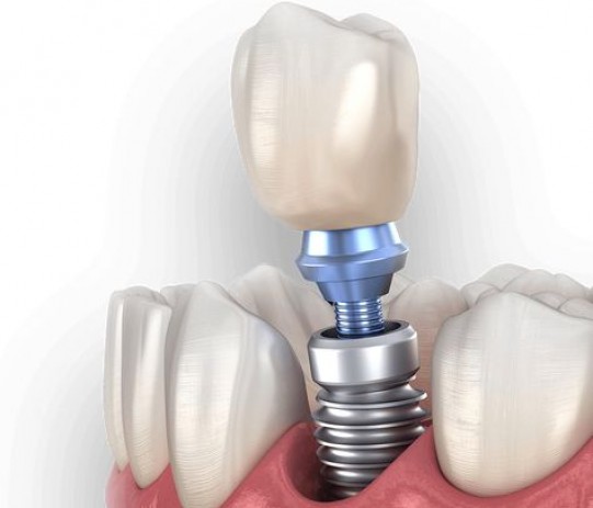 Trồng răng Implant đơn lẻ