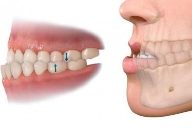 Bị móm có nên niềng răng?