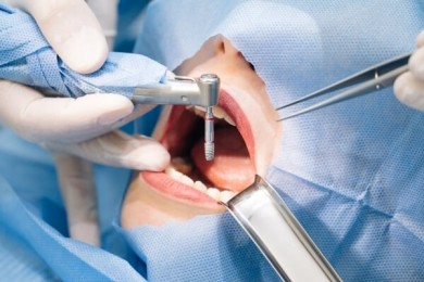 Trồng răng implant trong nha khoa là gì?