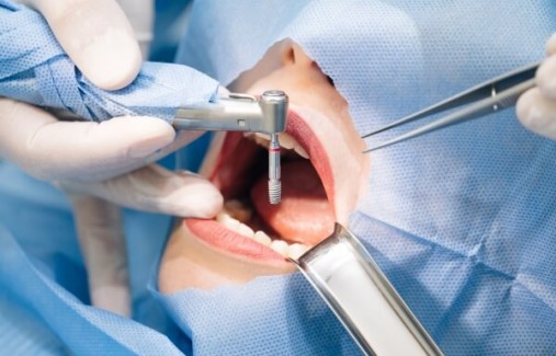 Trồng răng implant trong nha khoa là gì?