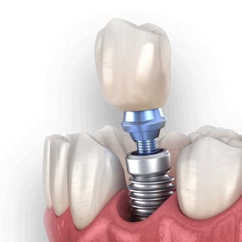 Trồng răng Implant đơn lẻ