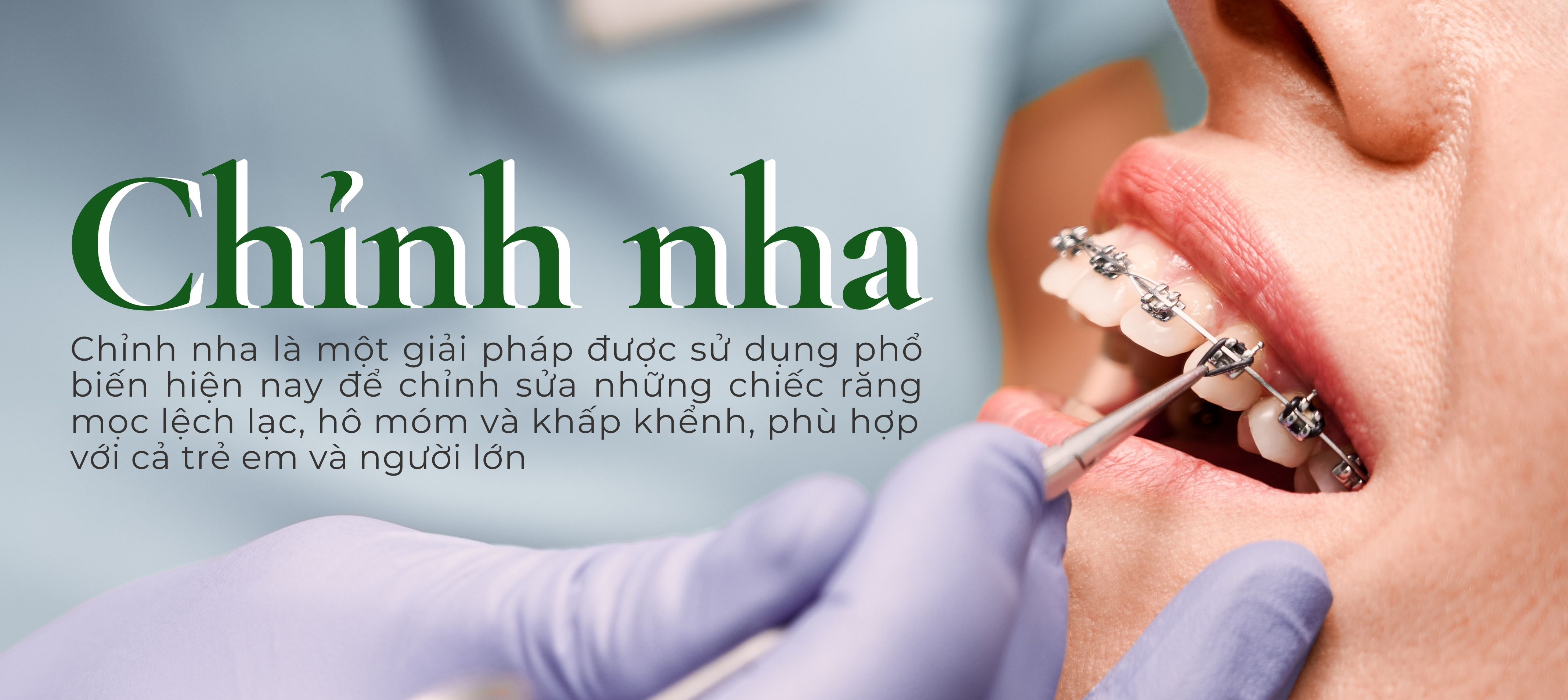 Niềng răng mắc cài