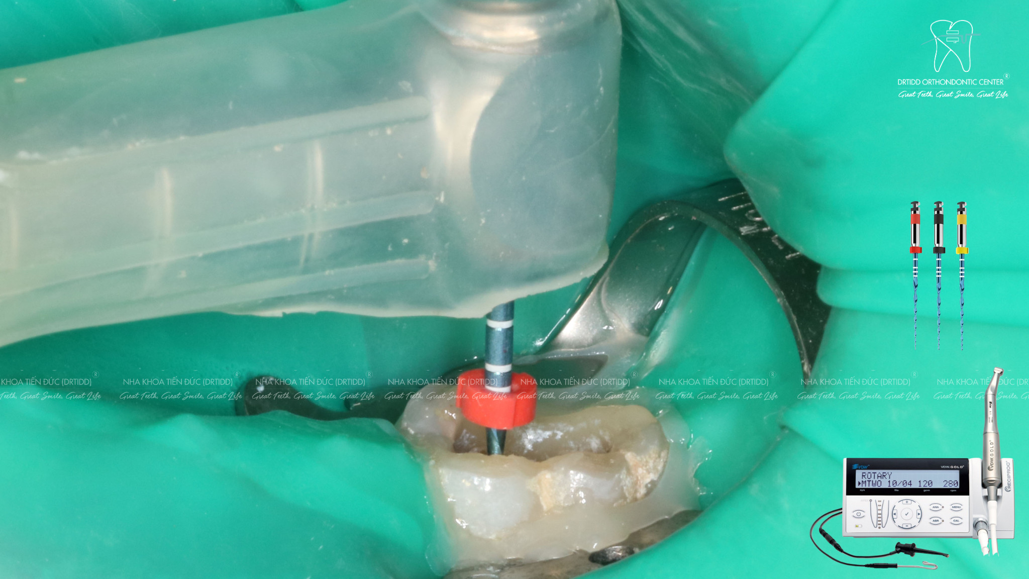 Điều trị tủy răng