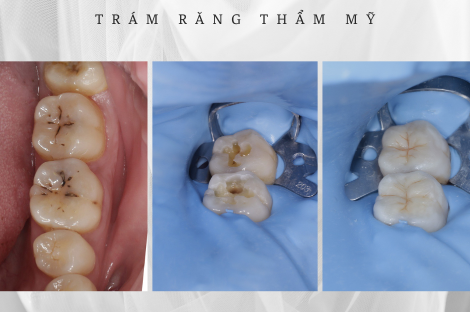 Trám răng thẩm mỹ