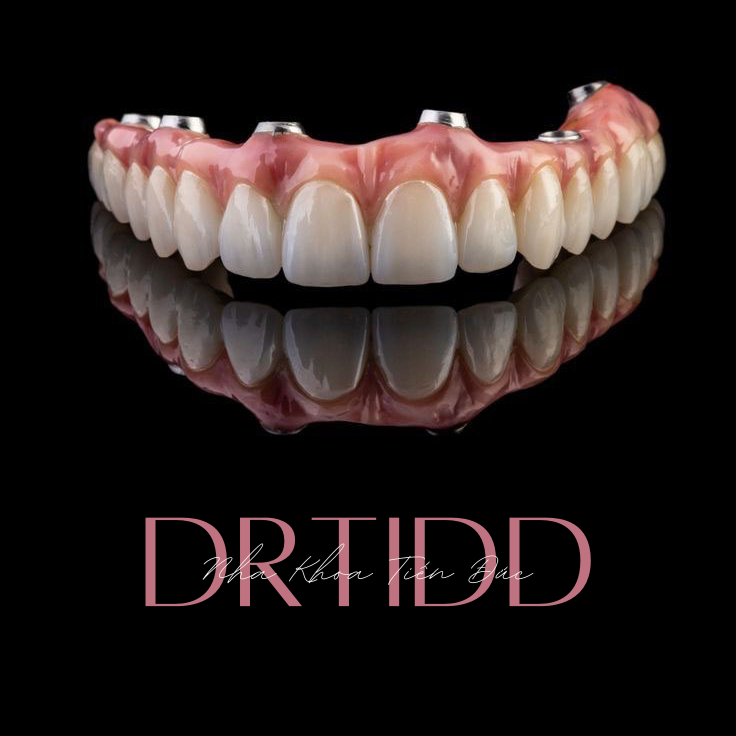 Trồng răng Implant toàn hàm